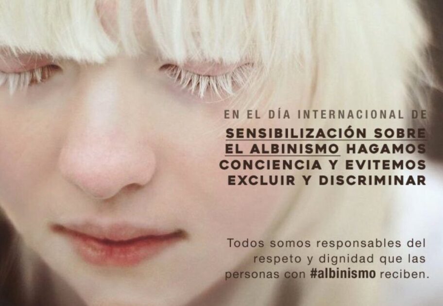 Albinos Solidarios Asociados| Conmemoran Día Internacional de Sensibilización sobre el Albinismo. UNA BELLEZA ÚNICA Y ESPACIAL